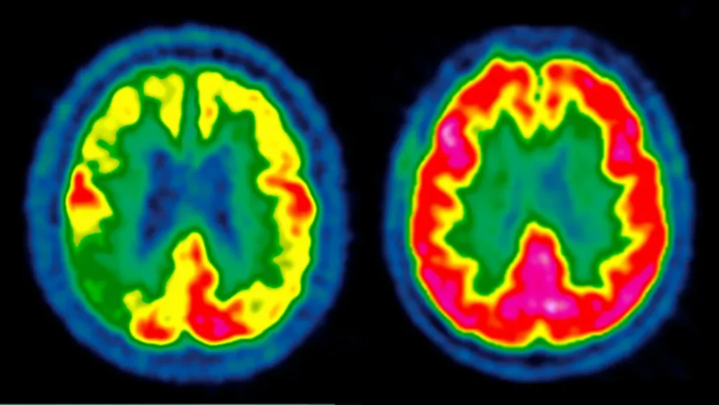 GLP-1 Drugs Show Potential to Slow Alzheimer’s Disease Progression, Review Highlights