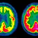 GLP-1 Drugs Show Potential to Slow Alzheimer’s Disease Progression, Review Highlights