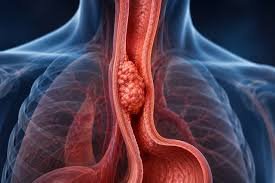 Cancer Therapeutics Market Gains New Viral Therapy Option as Telomelysin Launches in Japan for Esophageal Cancer