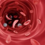 Sickle Cell Anemia Drug Access Gets New Push as WHO Expands Treatment Guidance for Children