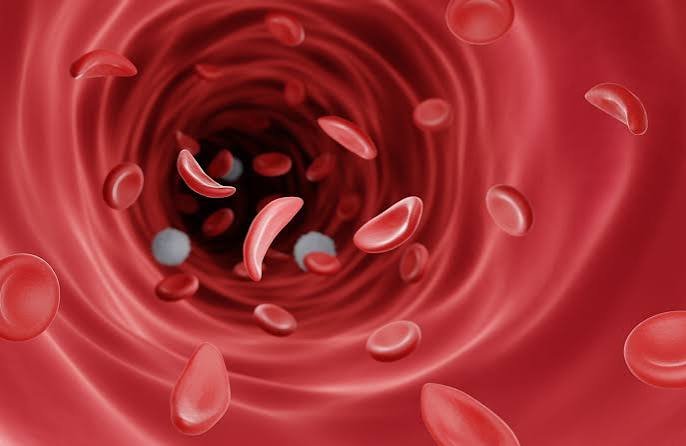 Sickle Cell Anemia Drug Access Gets New Push as WHO Expands Treatment Guidance for Children